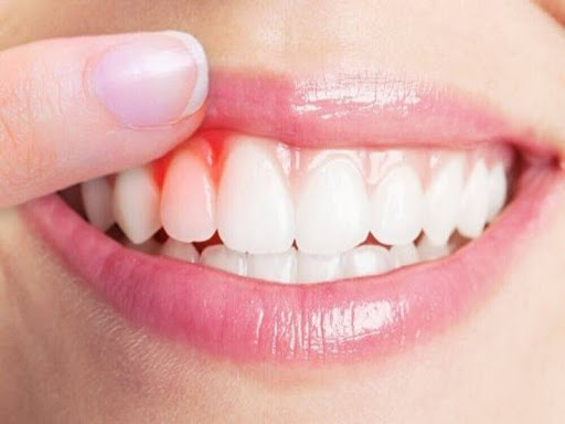 Niềng răng bị chảy máu nướu ? Nguyên nhân do đâu