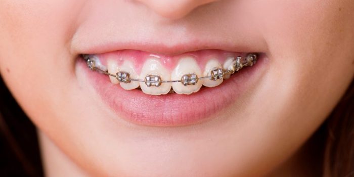 Niềng răng bị chảy máu nướu ? Nguyên nhân do đâu