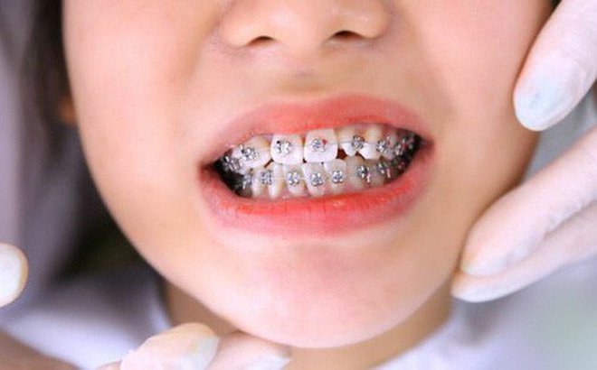 Niềng răng có bị đau không? Thời gian niềng răng là bao lâu?