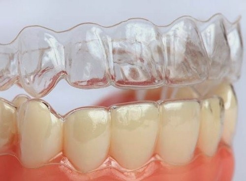 Niềng răng Invisalign và những điều cần biết về niềng răng không mắc cài