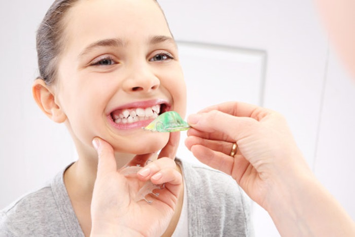 Niềng răng mất bao nhiêu thời gian? Phụ thuộc vào các yếu tố nào?