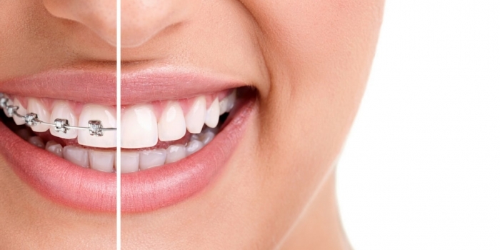 Niềng răng mất bao nhiêu thời gian? Phụ thuộc vào các yếu tố nào?