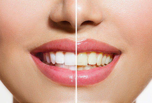 Quy trình tẩy trắng răng nha khoa như thế nào?