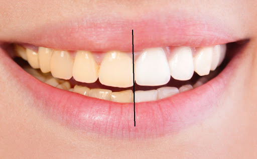 Quy trình tẩy trắng răng nha khoa như thế nào?