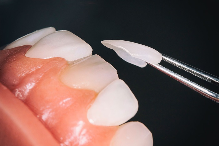 Sự khác nhau giữa bọc răng sứ và gắn răng sư Veneer