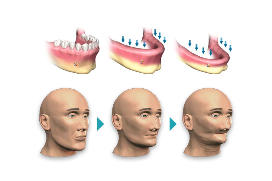 Tại sao cần phải trồng răng implant khi bị mất răng vĩnh viễn?