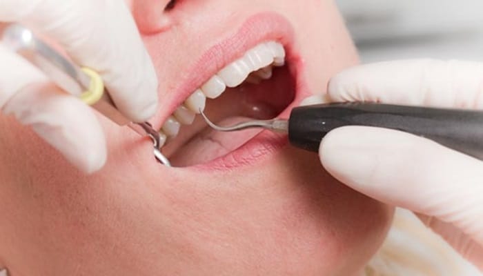 Tại sao nên tẩy trắng răng ngay lập tức? Nha khoa Ngọc Trai