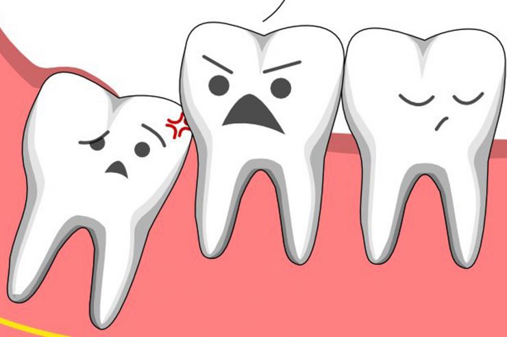 Tại sao phải nhổ răng khôn khi niềng răng? Phòng khám nha khoa uy tín