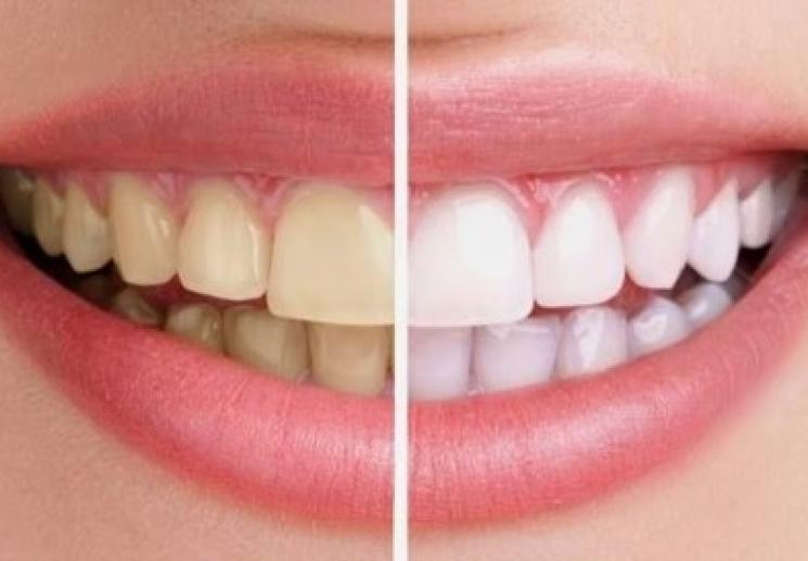 Tẩy trắng răng là gì? Nha khoa tẩy trắng răng uy tín ở HCM