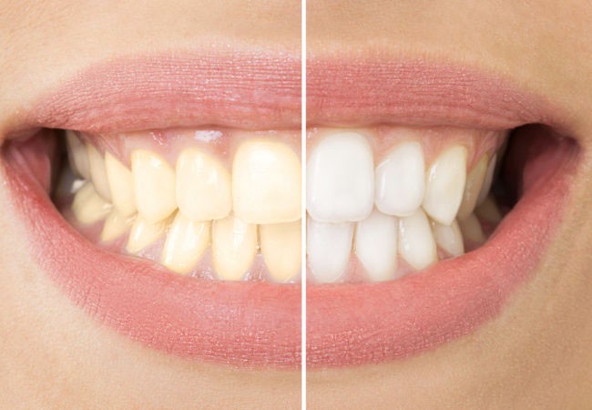 Tẩy trắng răng là gì? Nha khoa tẩy trắng răng uy tín ở HCM