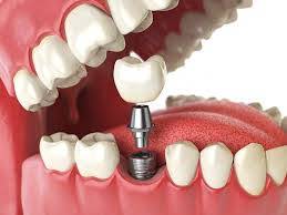 Tìm hiểu ưu nhược điểm của hàm răng giả tháo lắp