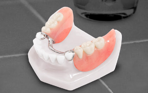 Tìm hiểu ưu nhược điểm của hàm răng giả tháo lắp
