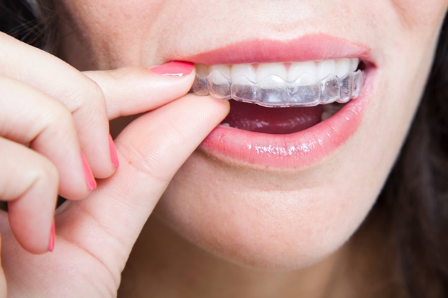 Tổng quan về phương pháp niềng răng trong suốt invisalign