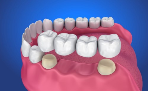 Trồng răng giả cố định là gì? Trồng răng giả có đau không?