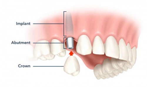Trồng răng giả cố định là gì? Trồng răng giả có đau không?
