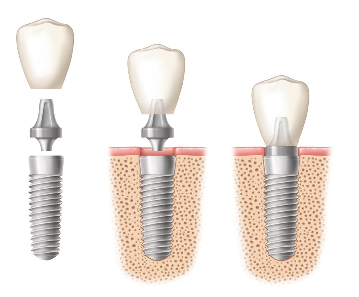 Trồng răng Implant có đau không? Nha khoa trồng implant uy tín