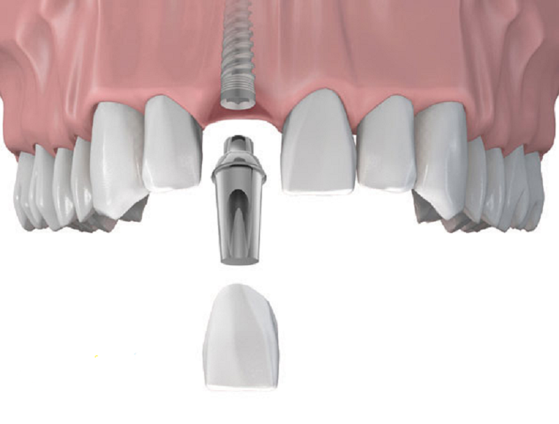 Trồng răng Implant có đau không? Nha khoa trồng implant uy tín