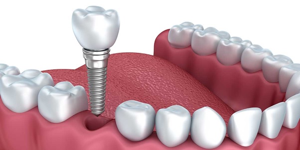 Trồng Răng Implant Là Gì? Ai Nên Trồng Răng Implant?