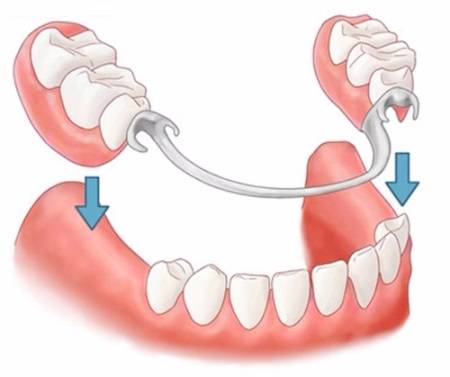 Trồng răng là gì? Nha khoa trồng răng uy tín ở HCM