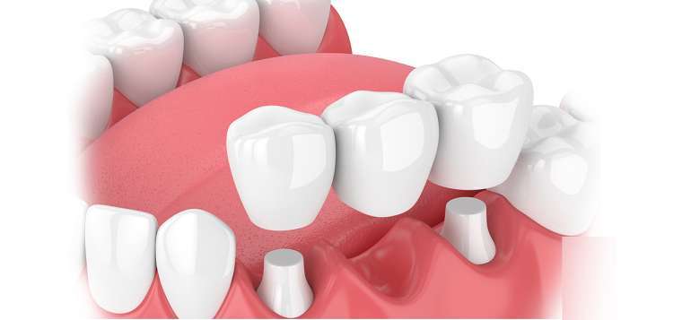 Trồng răng là gì? Nha khoa trồng răng uy tín ở HCM