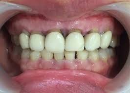 Trồng răng sứ bị hở  - Tổng hợp những nguyên nhân gây nên