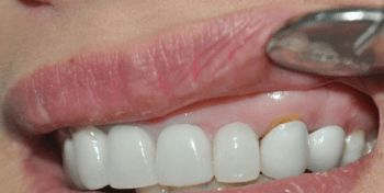 Trồng răng sứ bị hở  - Tổng hợp những nguyên nhân gây nên