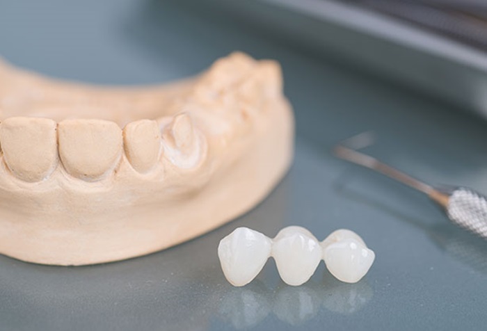 Trồng răng sứ trên răng implant thì nên chọn loại nào là tốt nhất?